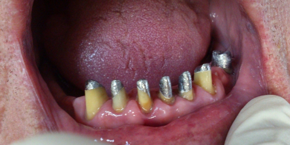 Протезирование при полном отсутствии зубов верхней челюсти и жевательных зубов нижней челюсти - фото №1