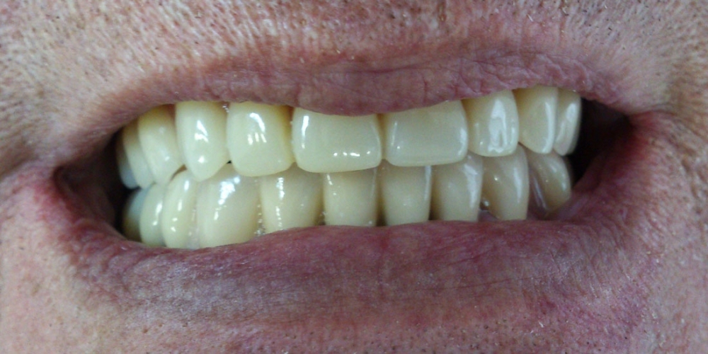 Протезирование при полном отсутствии зубов верхней челюсти и жевательных зубов нижней челюсти - фото №4