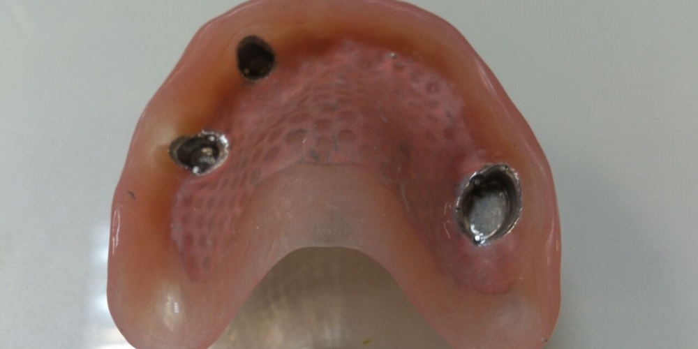 Бюгельный протез верхней челюсти с фиксацией на телескопические коронки - фото №2