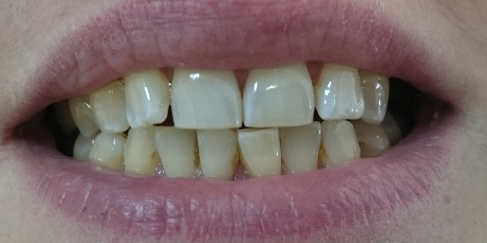 Пришлифовка суперконтактов фронтальных зубов с последующей полировкой - фото №2