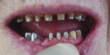 Восстановление формы и высоты фронтальных зубов и восполнение отсутствующих жевательных зубов - фото №1