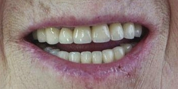 Восстановление формы и высоты фронтальных зубов и восполнение отсутствующих жевательных зубов - фото №2