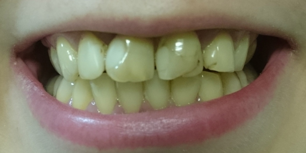 Керамические коронки на основе диоксида циркония (ZrO2) на 4-х фронтальных зубах - фото №1