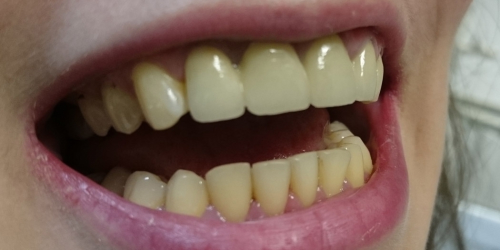 Керамические коронки на основе диоксида циркония (ZrO2) на 4-х фронтальных зубах - фото №2