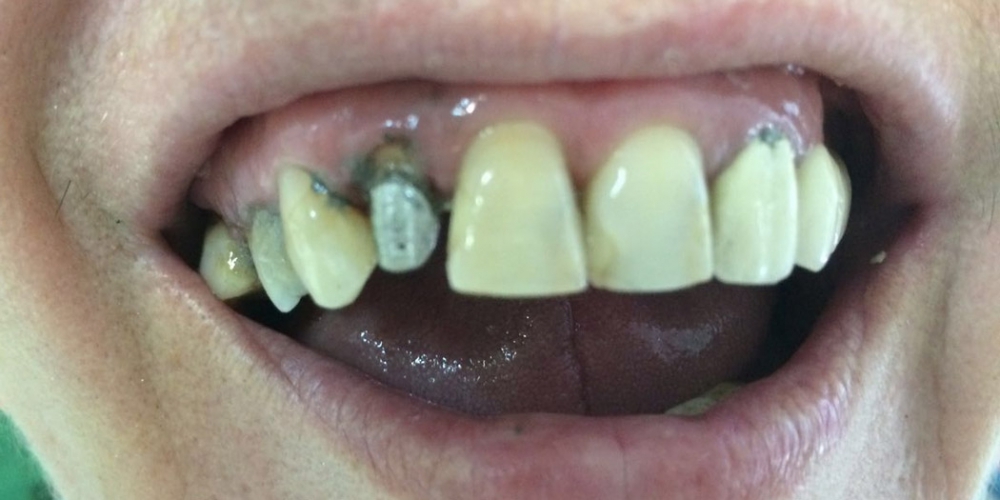 Восстановление эстетики и анатомической целостности зубного ряда верхней челюсти - фото №1