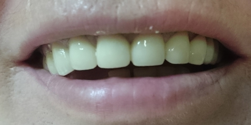 Восстановление эстетики и анатомической целостности зубного ряда верхней челюсти - фото №2