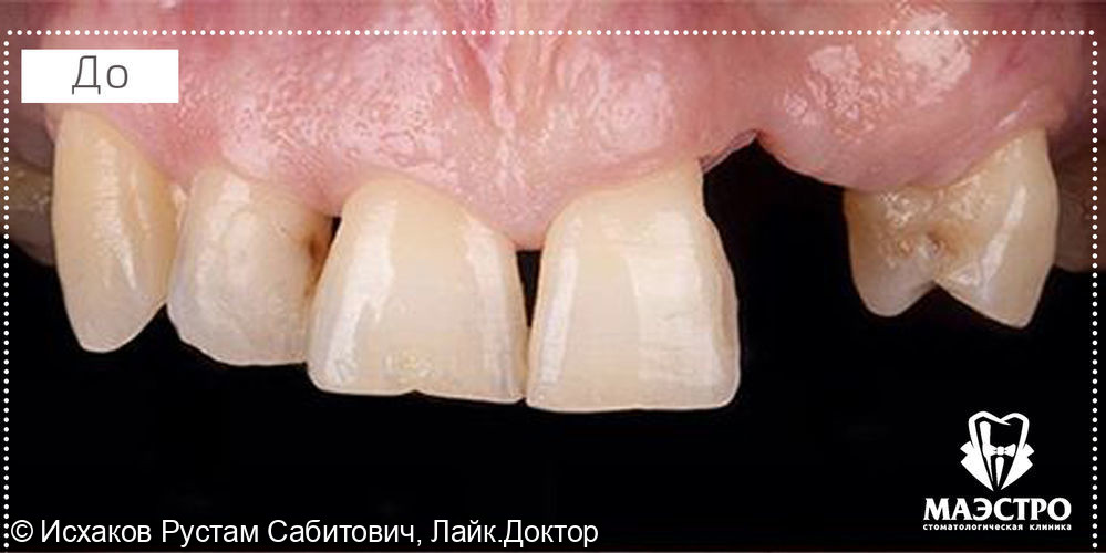 Кейс по имплантации и протезированию зубов - фото №1