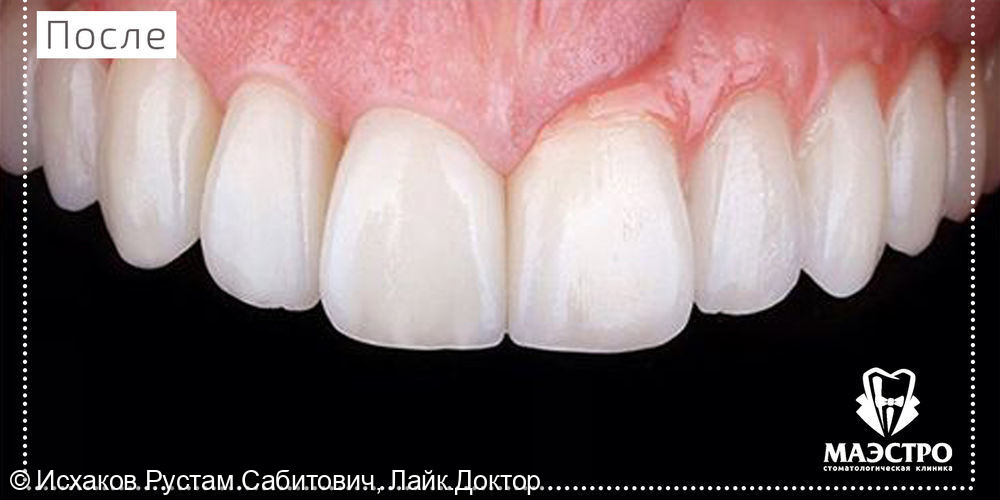 Кейс по имплантации и протезированию зубов - фото №2