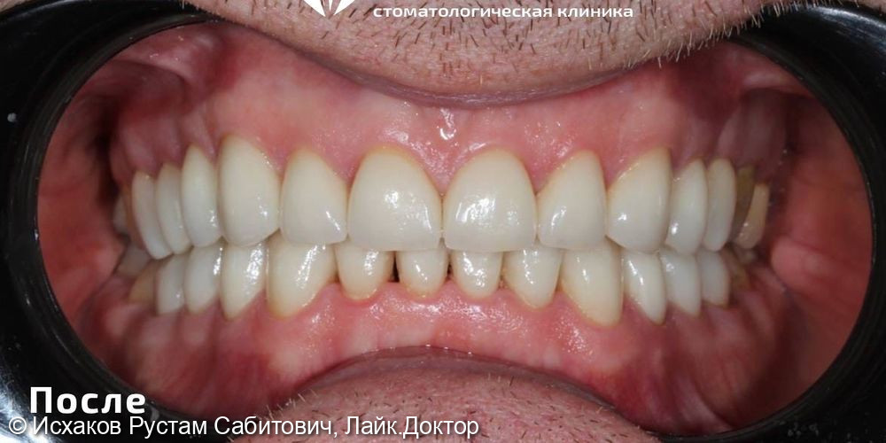Комплексное преображение зубов - фото №2