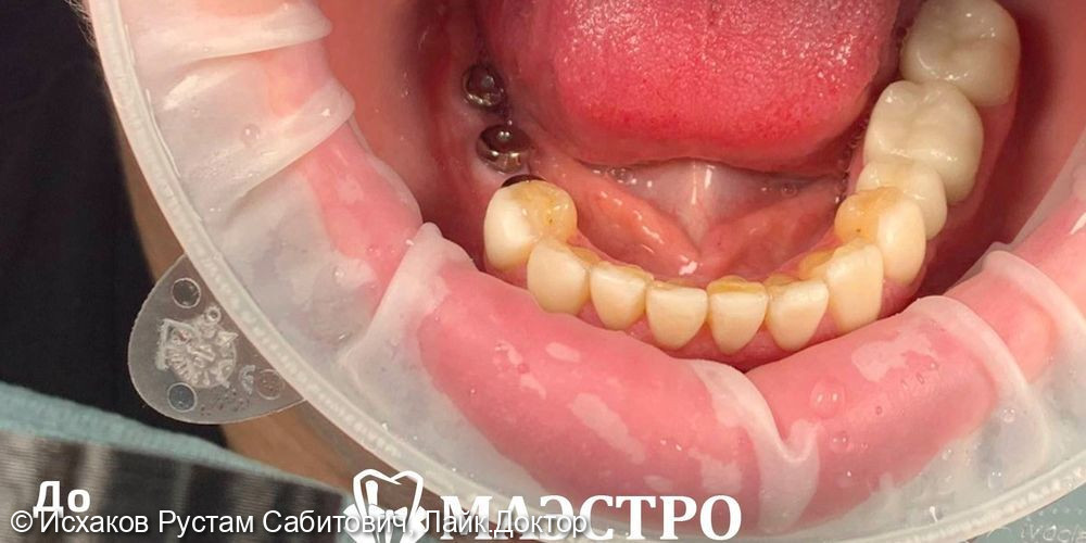 Восстановление жевательных зубов с помощью имплантов - фото №1