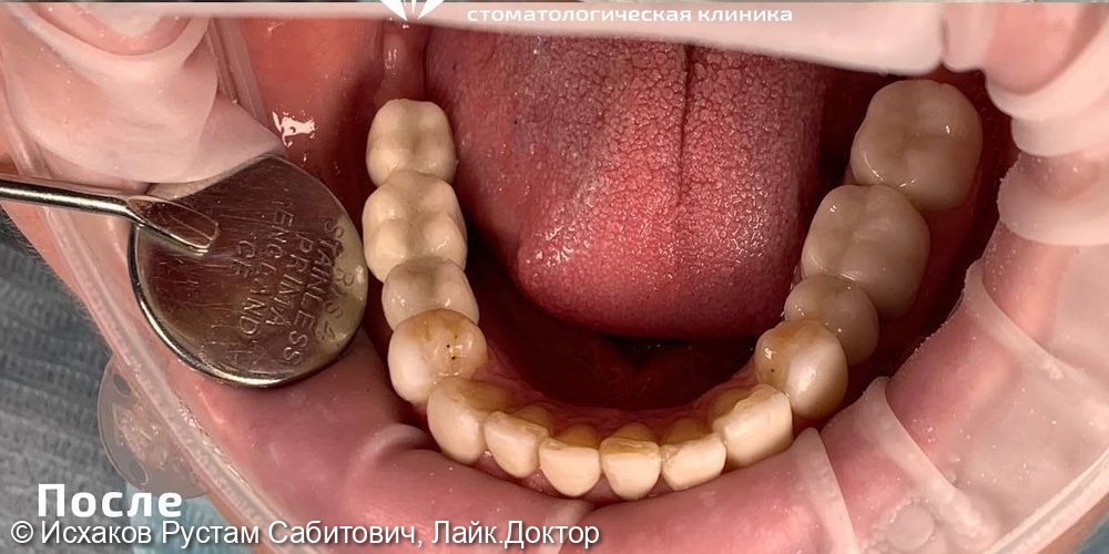 Восстановление жевательных зубов с помощью имплантов - фото №2