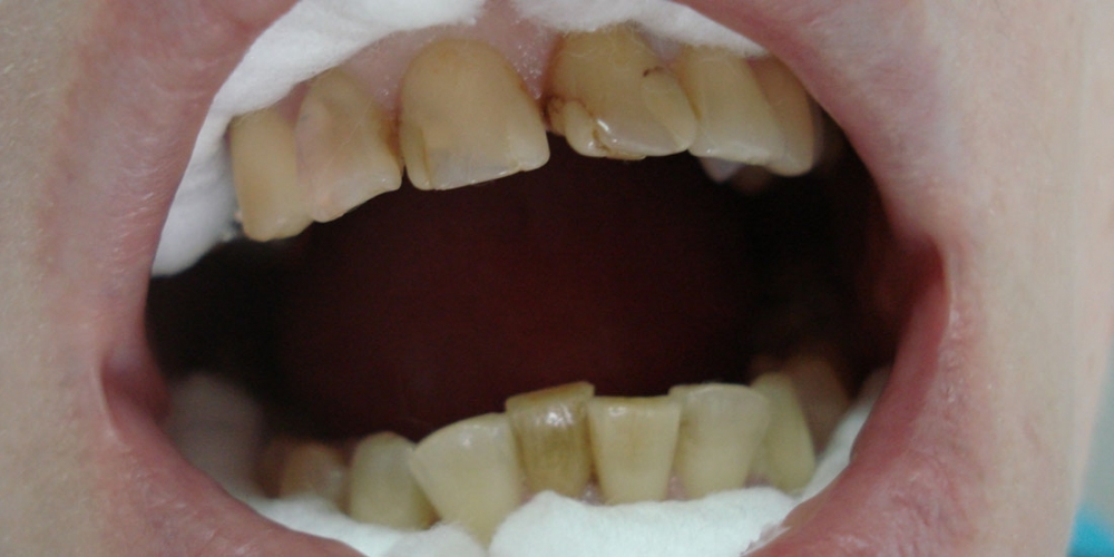 Эстетическая реставрация фронтальной группы зубов верхней челюсти - фото №1