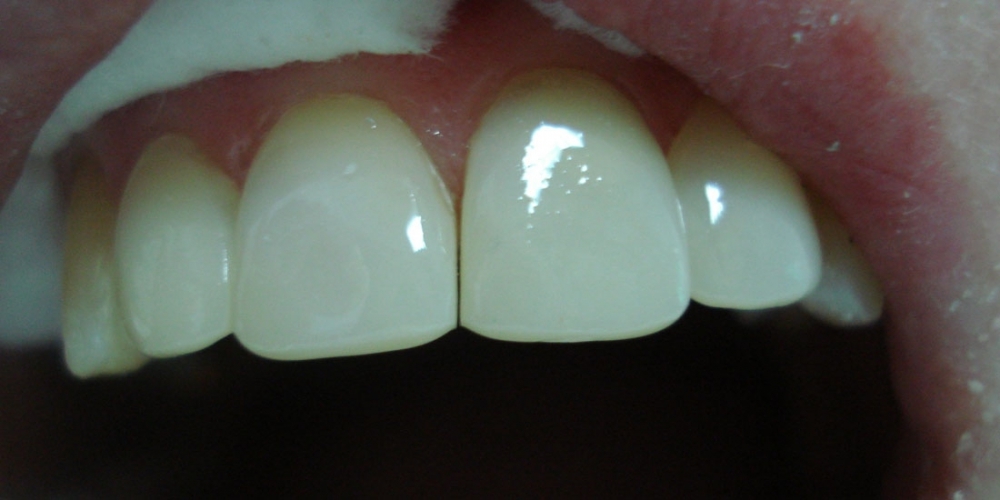 Эстетическая реставрация фронтальной группы зубов верхней челюсти - фото №3