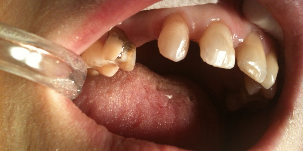 Одномоментное восполнение утраченного зуба с помощью специальной стекловолоконной ленты - фото №1
