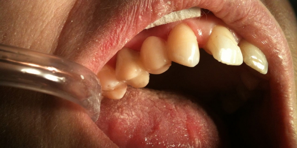 Одномоментное восполнение утраченного зуба с помощью специальной стекловолоконной ленты - фото №3