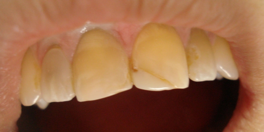 Реставрация фронтальной группы зубов верхней челюсти, внутриканальное отбеливание - фото №1