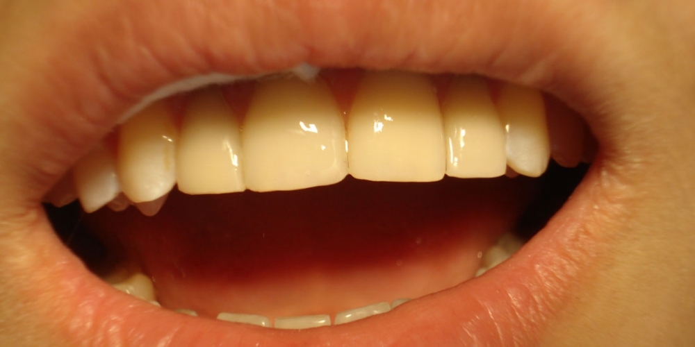 Реставрация фронтальной группы зубов верхней челюсти, внутриканальное отбеливание - фото №5