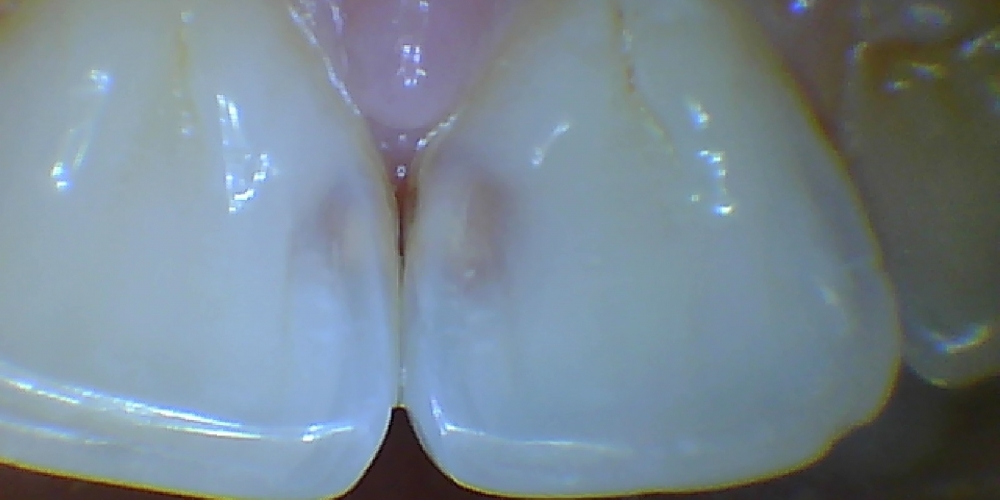 Лечение среднего кариеса передних зубов - фото №1