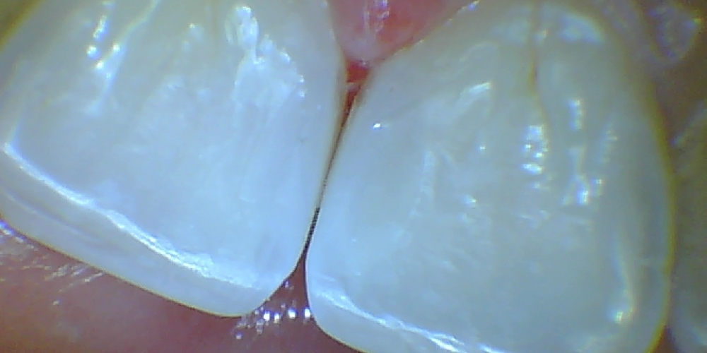 Лечение среднего кариеса передних зубов - фото №5