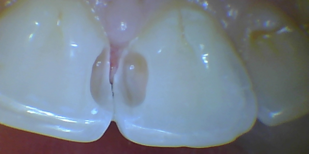 Лечение среднего кариеса передних зубов - фото №4