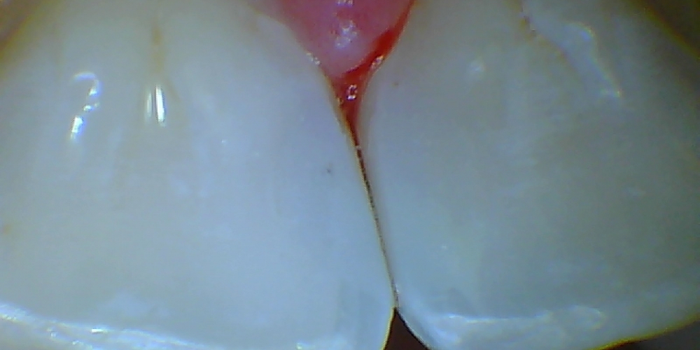 Лечение среднего кариеса передних зубов - фото №2