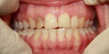 Эндоотбеливание (внутриканальное отбеливание депульпированного и впоследствии потемневшего зуба) - фото №1
