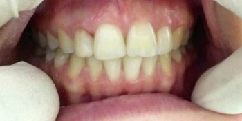 Эндоотбеливание (внутриканальное отбеливание депульпированного и впоследствии потемневшего зуба) - фото №2