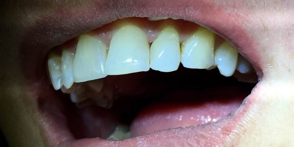 Эстетическая реставрация фронтальной группы зубов верхней челюсти - фото №2