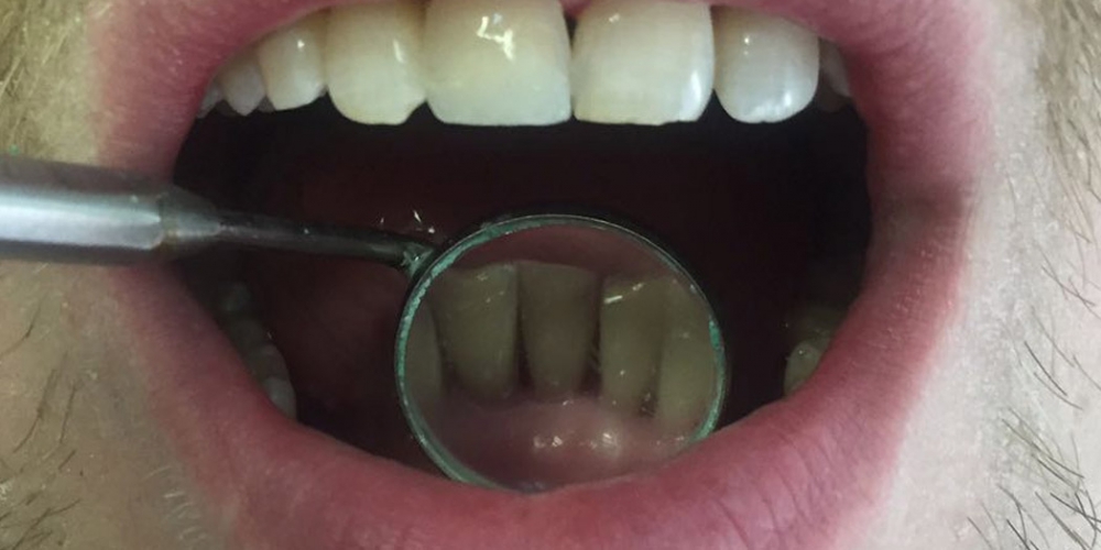 Снятие зубного камня ультразвуковым скалером пр-ва NSK - фото №2