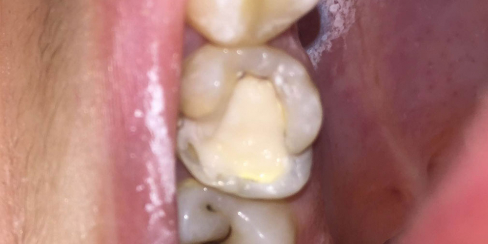 Замена несостоятельной пломбы зуба 1.6, рецидив кариеса - фото №1
