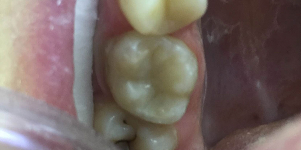 Замена несостоятельной пломбы зуба 1.6, рецидив кариеса - фото №3