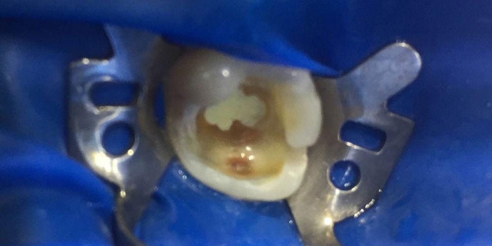 Замена несостоятельной пломбы зуба 1.6, рецидив кариеса - фото №2