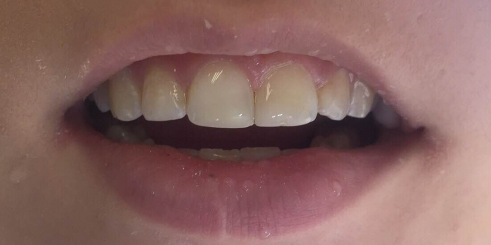 Эстетическое восста­новление скола перед­него зуба - фото №2