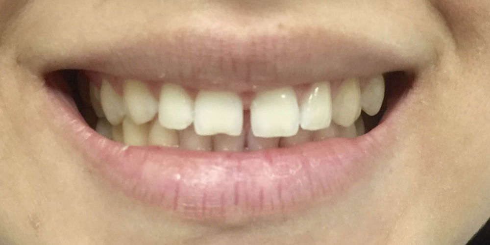 Изготовление керамических (фарфоровых) виниров E-max на фронтальную группу зубов верхней челюсти - фото №1