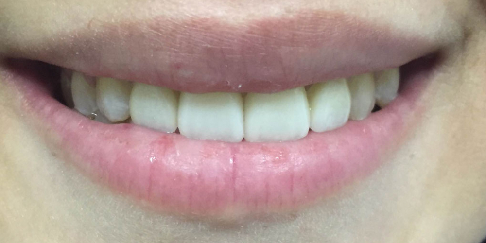 Изготовление керамических (фарфоровых) виниров E-max на фронтальную группу зубов верхней челюсти - фото №2