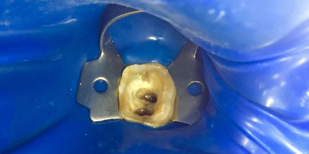 Лечение острого пульпита зуба 3.6 в одно посещение - фото №1