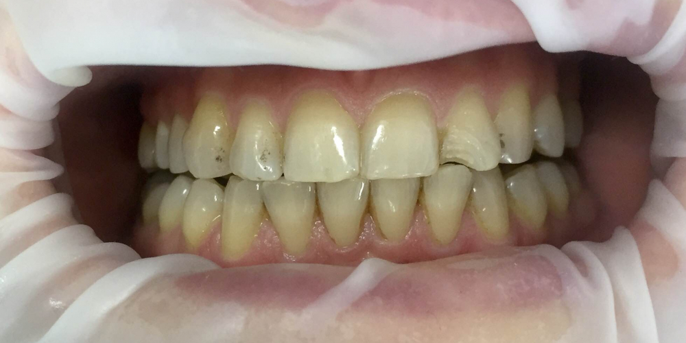 Проведена эстетическая реставрация зуба 2.2, материал Filtek Ultimate - фото №1