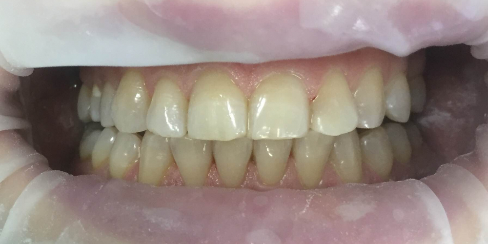Проведена эстетическая реставрация зуба 2.2, материал Filtek Ultimate - фото №2