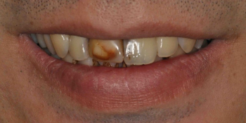 Восстановление передних зубов из композитного материала и безметалловой коронки - фото №1