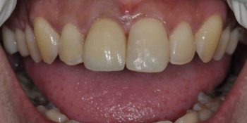 Восстановление передних зубов из композитного материала и безметалловой коронки - фото №4