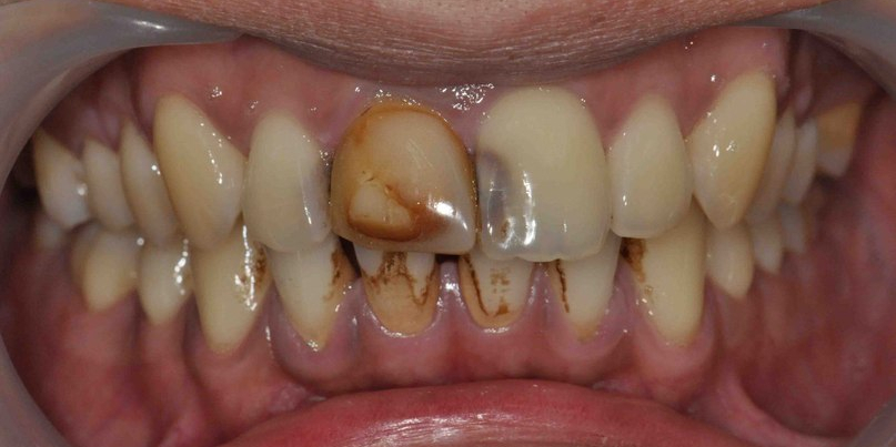 Восстановление передних зубов из композитного материала и безметалловой коронки - фото №3