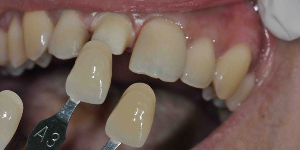 Восстановление передних зубов из композитного материала и безметалловой коронки - фото №2