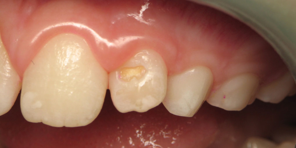 Лечение клиновидного дефекта 2-го центрального зуба - фото №1