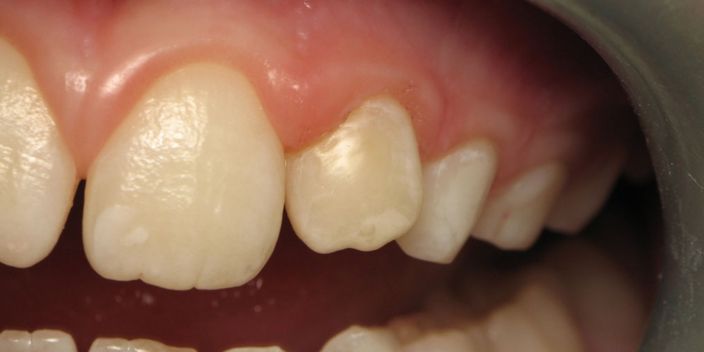 Лечение клиновидного дефекта 2-го центрального зуба - фото №2