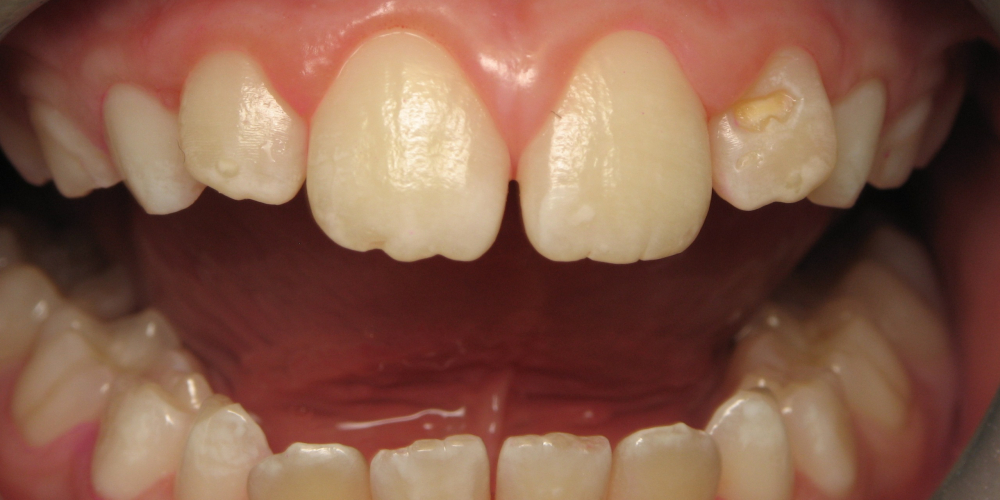 Окрашивание зубов, профессиональная гигиена зубов - фото №3