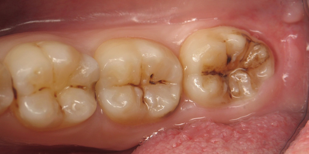 Лечение глубокого кариеса с установкой световой пломбы 3 зубов - фото №1