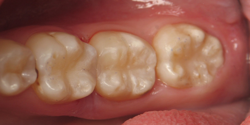 Лечение глубокого кариеса с установкой световой пломбы 3 зубов - фото №2