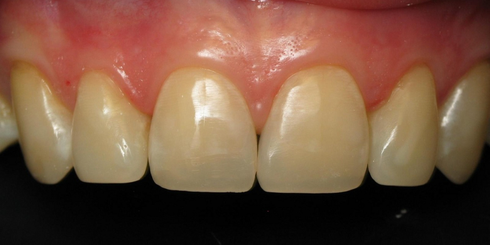 Восстановление режущего края передних зубов - фото №2