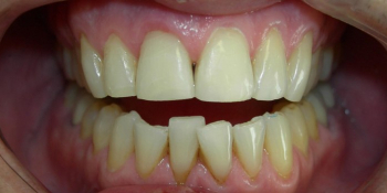 Наращивание переднего зуба, скол зуба, художественная реставрация - фото №2