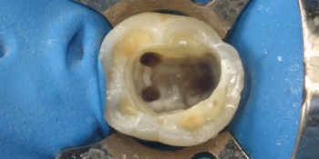 Лечение каналов зуба под микроскопом с наложением пломбы - фото №1